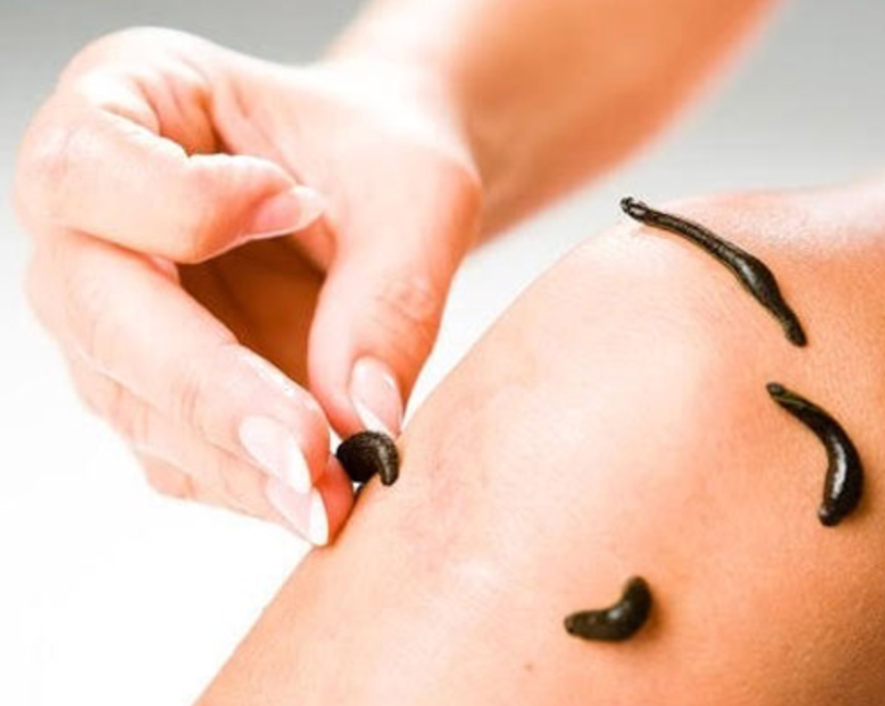 Rakta Moksha (leeches) Blood letting